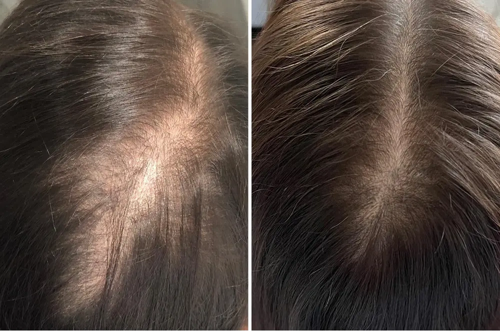 Karen S., 55 &mdash; crown, before and after 90 days